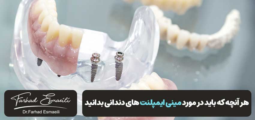 هر آنچه که باید در مورد مینی ایمپلنت های دندانی بدانید | دکتر فرهاد اسماعیلی