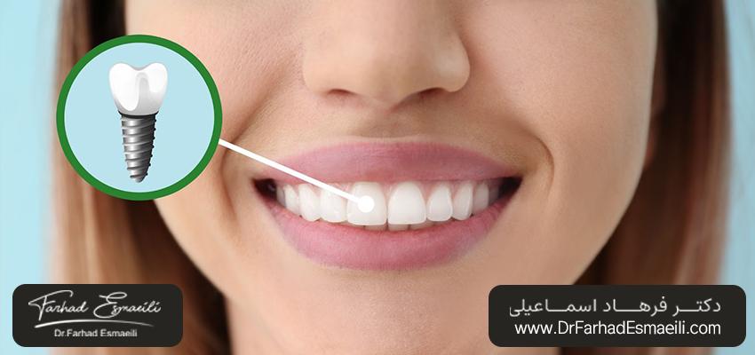 آیا ایمپلنت دندان میتواند جایگزین عصبکشی دندان شود؟ | دکتر فرهاد اسماعیلی در اصفهان