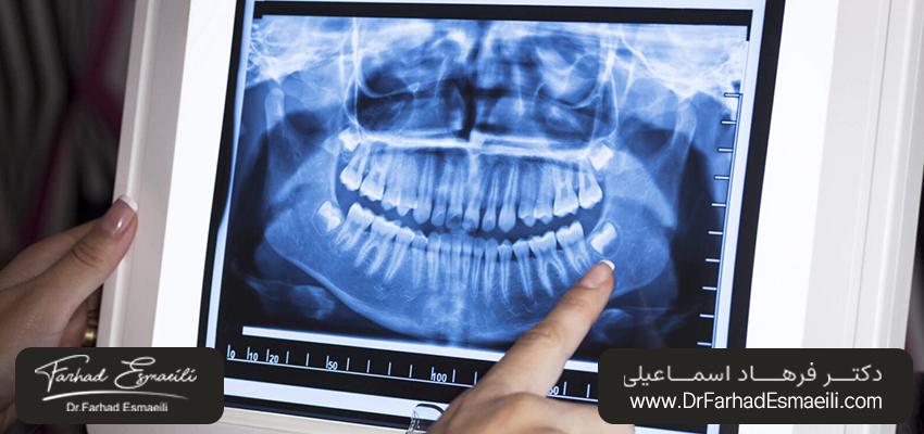 نحوه کار اشعه ایکس دندان | دکتر فرهاد اسماعیلی در اصفهان