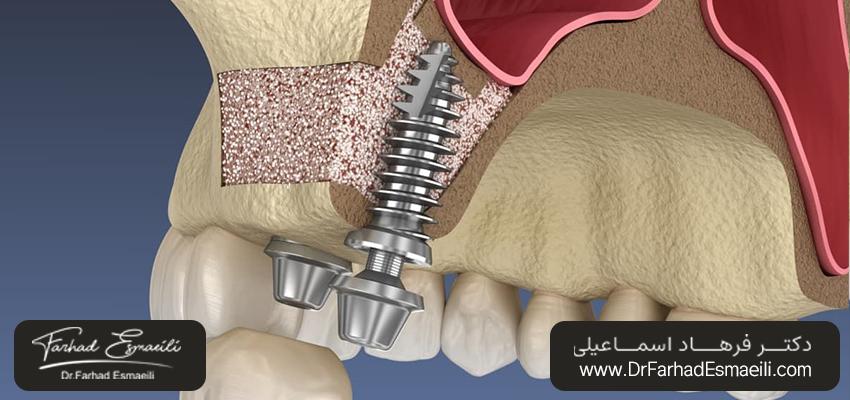 کاشت ایمپلنت دندان بعد از لیفت سینوس چگونه انجام می‌شود؟ | دکتر فرهاد اسماعیلی