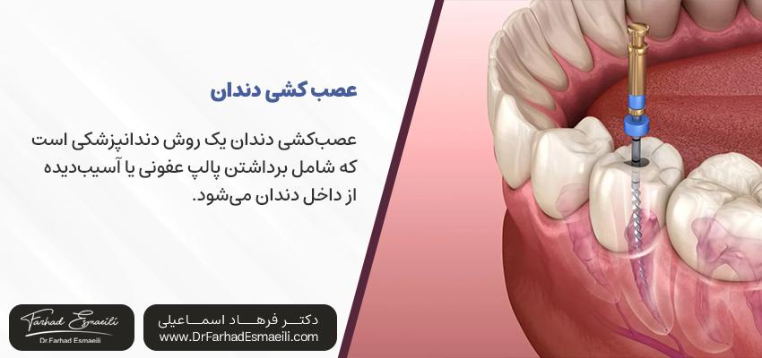 عصبکشی دندان چیست؟ | دکتر فرهاد اسماعیلی