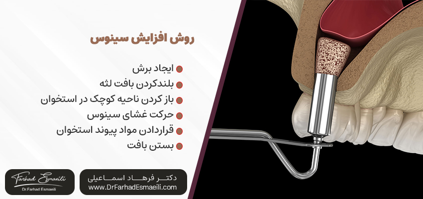 روش افزایش سینوس | دکتر فرهاد اسماعیلی