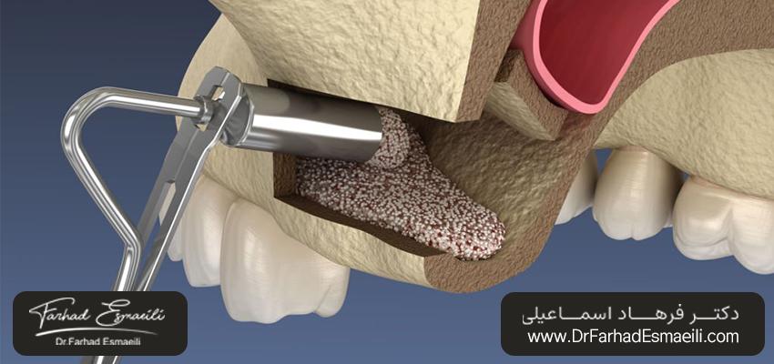 درمان سینوس لیفت | دکتر فرهاد اسماعیلی