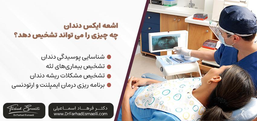 اشعه ایکس دندان چه چیزی را می‌تواند تشخیص دهد؟ | مطب دکتر فرهاد اسماعیلی در اصفهان