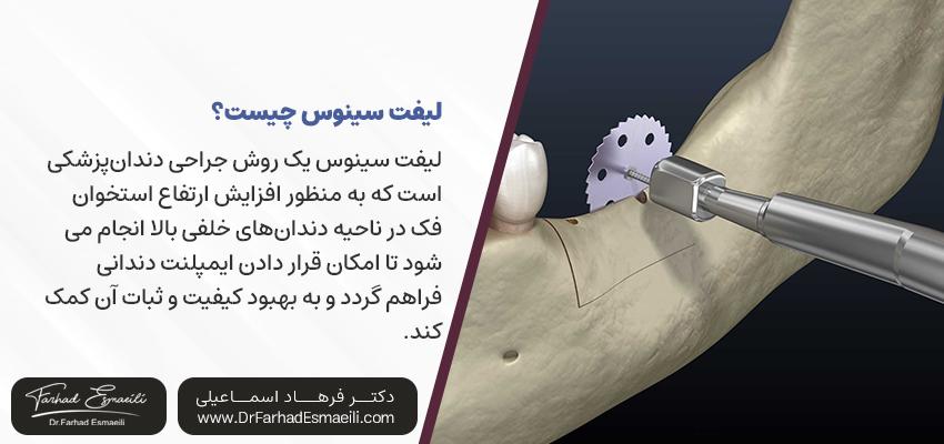 لیفت سینوس چیست؟ | دکتر فرهاد اسماعیلی