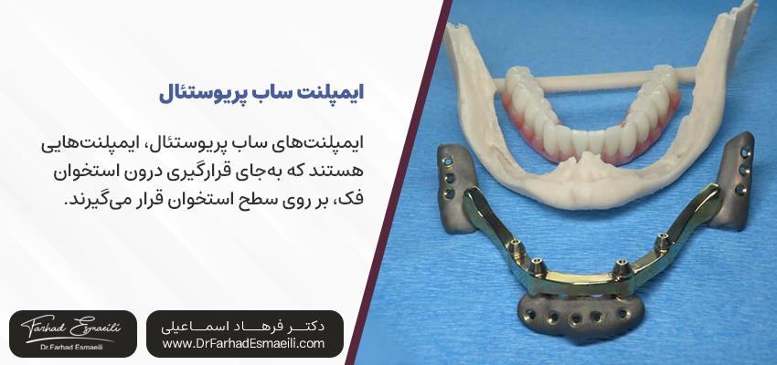 ایمپلنت ساب پریوستئال چیست؟ | دکتر فرهاد اسماعیلی در اصفهان