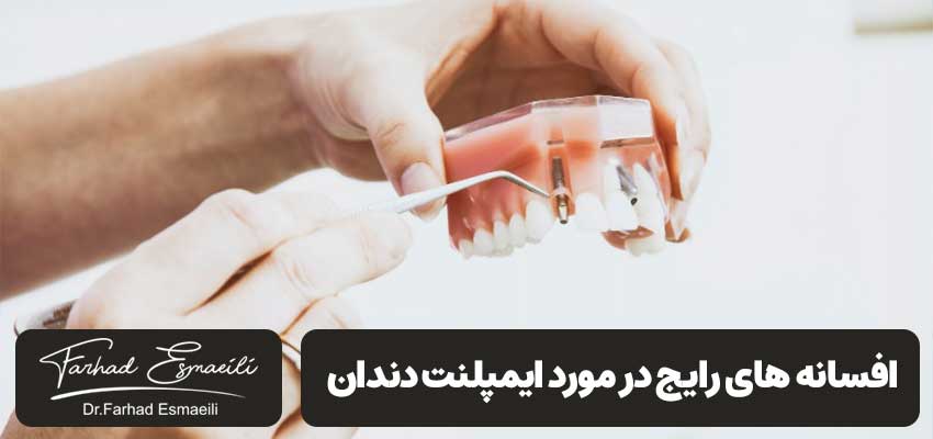 افسانه های رایج در مورد ایمپلنت دندان | دکتر فرهاد اسماعیلی