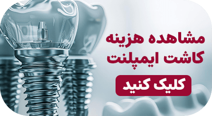 هزینه کاشت ایمپلنت