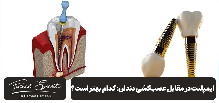ایمپلنت در مقابل عصبکشی دندان: کدام گزینه بهتر است؟ | دکتر فرهاد اسماعیلی