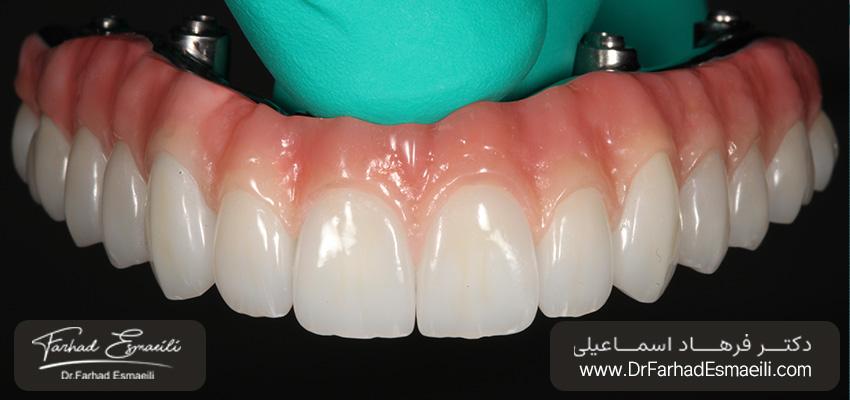 مزایا و معایب پروتزهای هیبریدی | دکتر فرهاد اسماعیلی