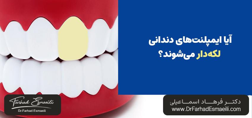آیا ایمپلنتهای دندانی لکهدار میشوند؟ | دکتر فرهاد اسماعیلی