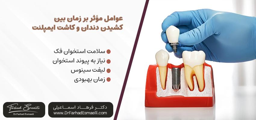 عوامل مؤثر بر زمان بین کشیدن دندان و کاشت ایمپلنت | دکتر فرهاد اسماعیلی