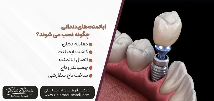 مراحل نصب اباتمنتهای دندانی | دکتر فرهاد اسماعیلی در اصفهان
