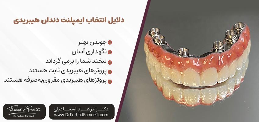 دلایل انتخاب ایمپلنت هیبریدی | دکتر فرهاد اسماعیلی در اصفهان