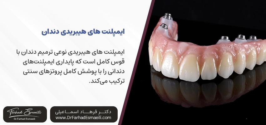 ایمپلنتهای هیبریدی چیست؟ | دکتر فرهاد اسماعیلی در اصفهان