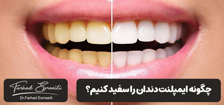 چگونه ایمپلنت دندان را سفید کنیم؟ | دکتر فرهاد اسماعیلی
