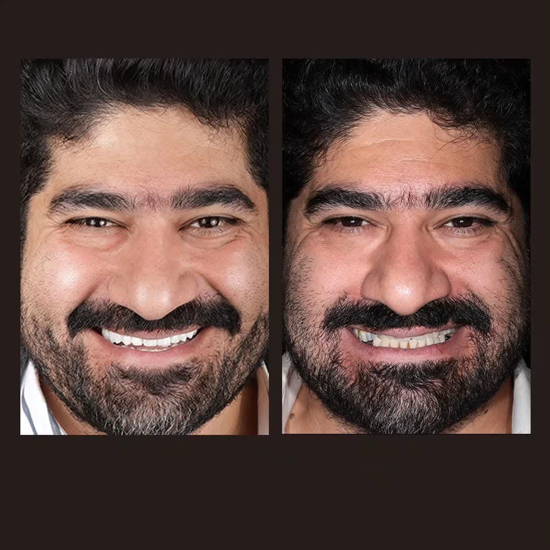 کاشت ایمپلنت دیجیتال بیمار عزیز از شهر سمنان