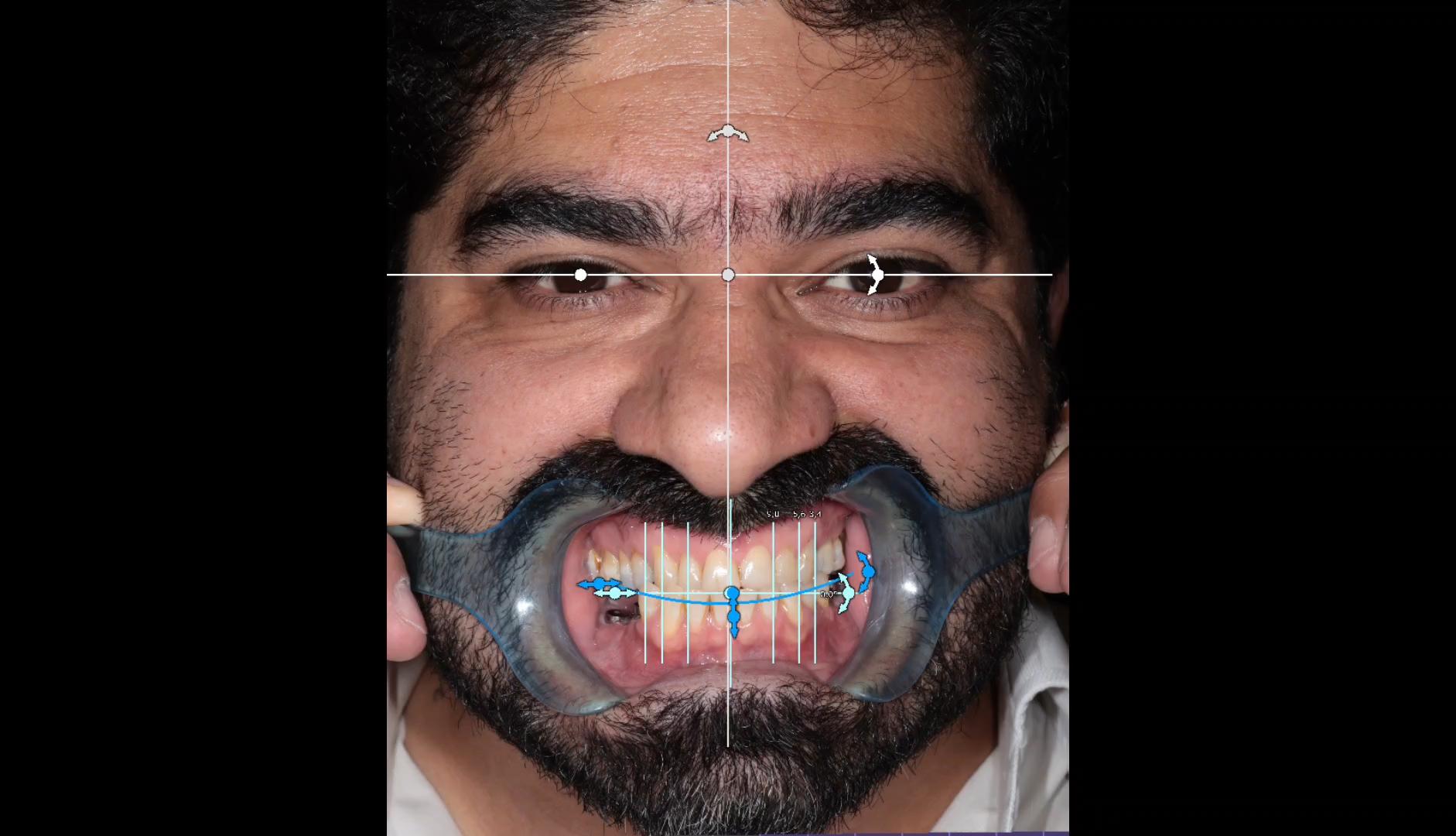 کاشت ایمپلنت دیجیتال بیمار عزیز از شهر سمنان