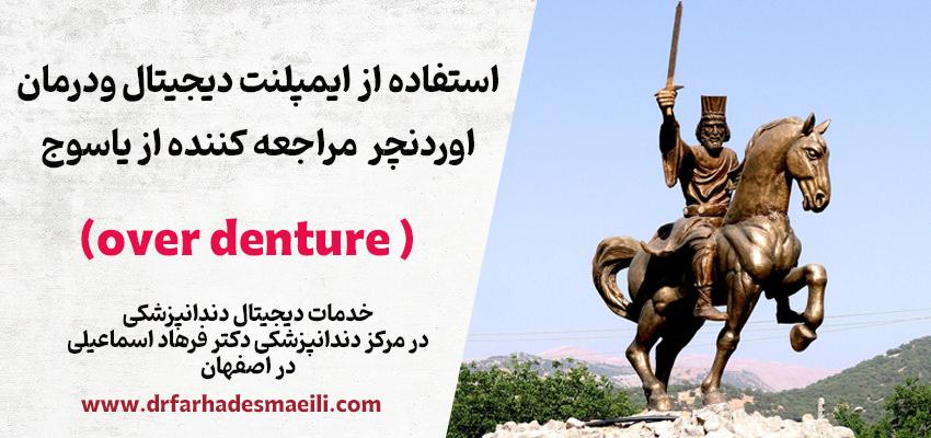 کاشت ایمپلمت دیجیتال مراجعه کننده عزیز از یاسوج توسط دکتر فرهاد اسماعیلی