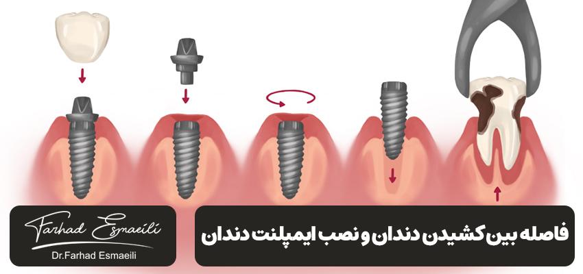 چه مدت بعد از کشیدن دندان میتوانید ایمپلنت دندانی داشته باشید؟ | دکتر فرهاد اسماعیلی در اصفهان