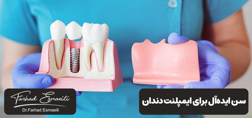 آنچه باید در مورد سن ایدهآل برای ایمپلنت دندان بدانید! | دکتر فرهاد اسماعیلی