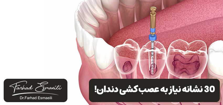 30 نشانه نیاز به عصب کشی دندان | دکتر فرهاد اسماعیلی