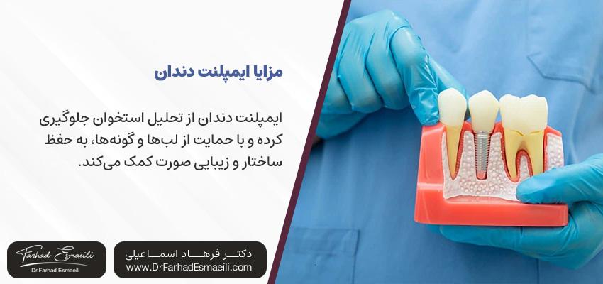 فواید باورنکردنی ایمپلنت دندان | دکتر فرهاد اسماعیلی