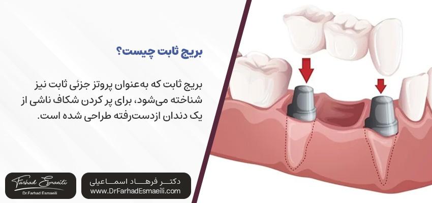 بریج ثابت چیست؟ | دکتر فرهاد اسماعیلی در اصفهان