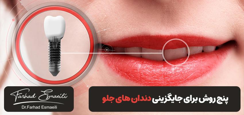 از دست دادن دندان های جلو؟ در اینجا 5 راه برای جایگزینی آنها وجود دارد! | دکتر فرهاد اسماعیلی