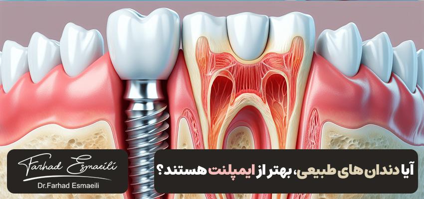 آیا دندان های طبیعی بهتر از ایمپلنت هستند؟ | دکتر فرهاد اسماعیلی
