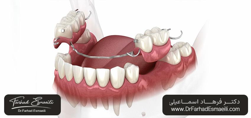 آیا فلیپرها جلوی جابجایی دندان را می‌گیرند؟ | دکتر فرهاد اسماعیلی