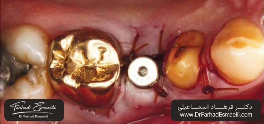 بخیههای منقطع ساده | دکتر فرهاد اسماعیلی