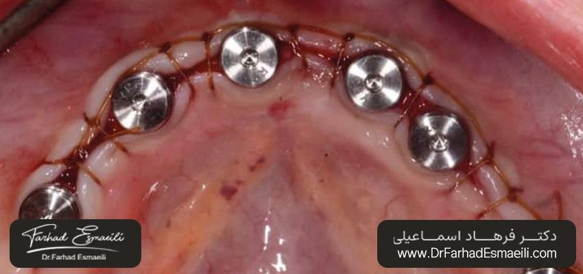 بخیههای پیوسته | بخیه زدن ایمپلنت دندان