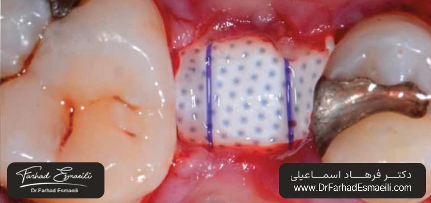 بخیه‌های تشک افقی | دکتر اسماعیلی، بهترین متخصص ایمپلنت دیجیتال اصفهان