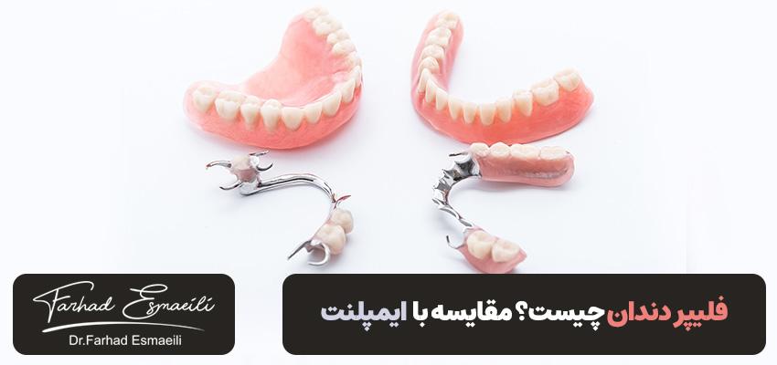 فلیپر دندان چیست؟ مقایسه با ایمپلنت | دکتر فرهاد اسماعیلی