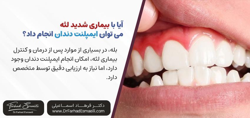 آیا میتوانم با بیماری شدید لثه ایمپلنت دندان بگذارم؟ | دکتر فرهاد اسماعیلی در اصفهان