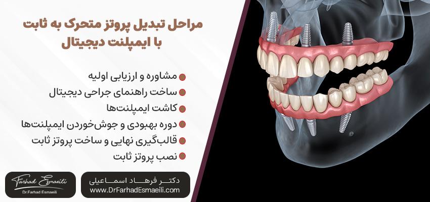 مراحل تبدیل دست دندان متحرک به ثابت با ایمپلنت دیجیتال | دکتر فرهاد اسماعیلی در اصفهان