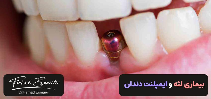 بیماری لثه و ایمپلنت دندان | عوارض خطرناک | دکتر فرهاد اسماعیلی