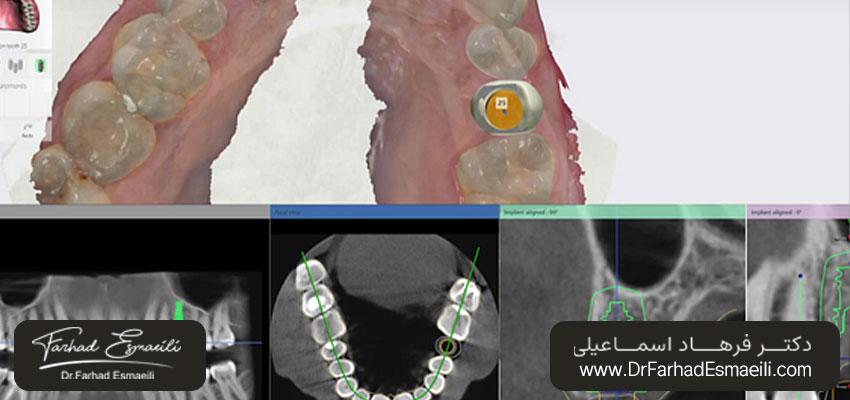داده‌های CBCT برای بررسی تراکم استخوان، سینوس یا عصب آلوئولار تحتانی | ایمپلنت دیجیتال اصفهان