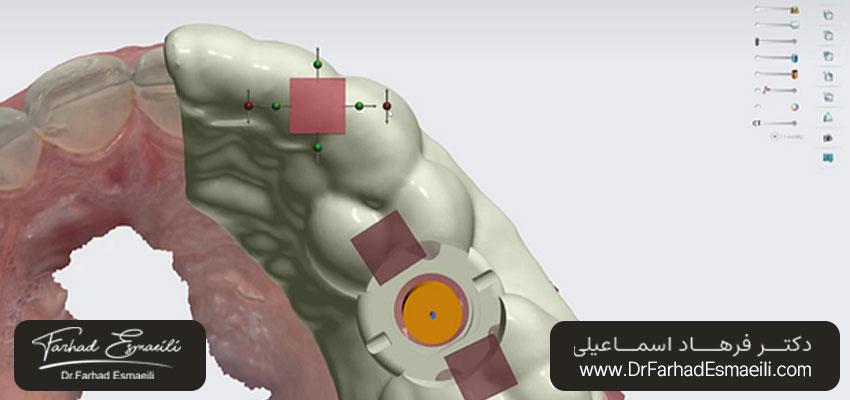 طراحی راهنمای جراحی ایمپلنت دندان | بهترین مطب ایمپلنت دیجیتال دندان