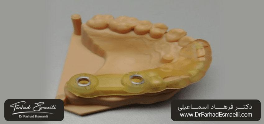 تولید ایمپلنت دندان از طریق پرینت سه بعدی | دکتر فرهاد اسماعیلی در اصفهان