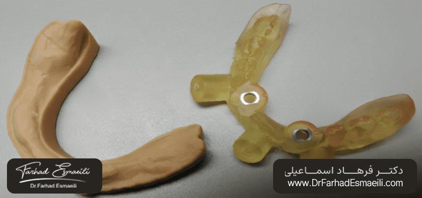 راهنمای جراحی استریولیتوگرافی با پشتیبانی از مخاط | مطب ایمپلنت دیجیتال دکتر فرهاد اسماعیلی