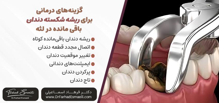 گزینه‌های درمانی برای ریشه شکسته دندان باقی مانده در لثه | دکتر فرهاد اسماعیلی در اصفهان