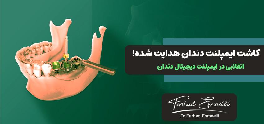 نکاتی در مورد کاشت ایمپلنت دندانی هدایت شده! | دکتر فرهاد اسماعیلی