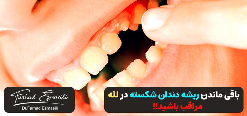 باقی ماندن ریشه دندان شکسته در لثه | مراقب باشید!! | دکتر فرهاد اسماعیلی