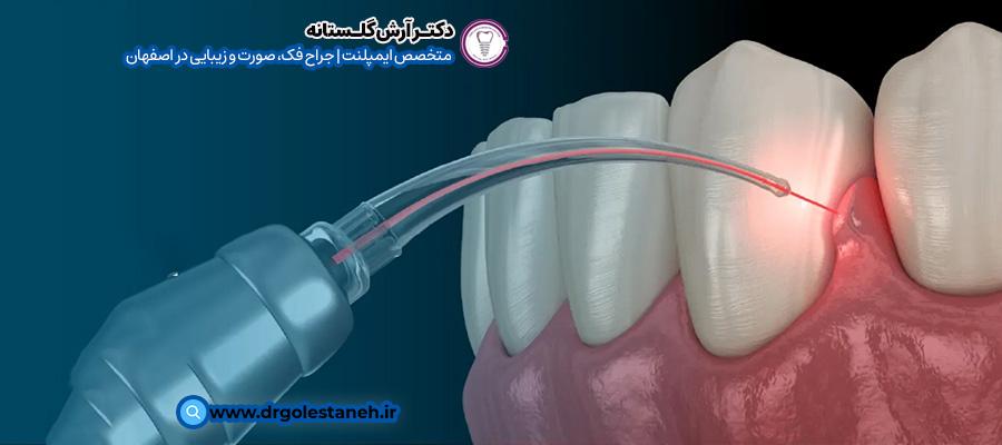مزایا درمان لثه با لیزر | دکتر فرهاد اسماعیلی در اصفهان