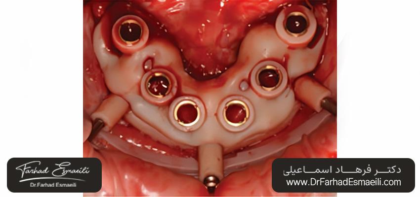 راهنماهای استخوانی سرچیکال گاید ایمپلنت دندان | دکتر فرهاد اسماعیلی