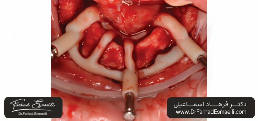 راهنماهای استخوانی سرچیکال گاید ایمپلنت دندان | دکتر فرهاد اسماعیلی