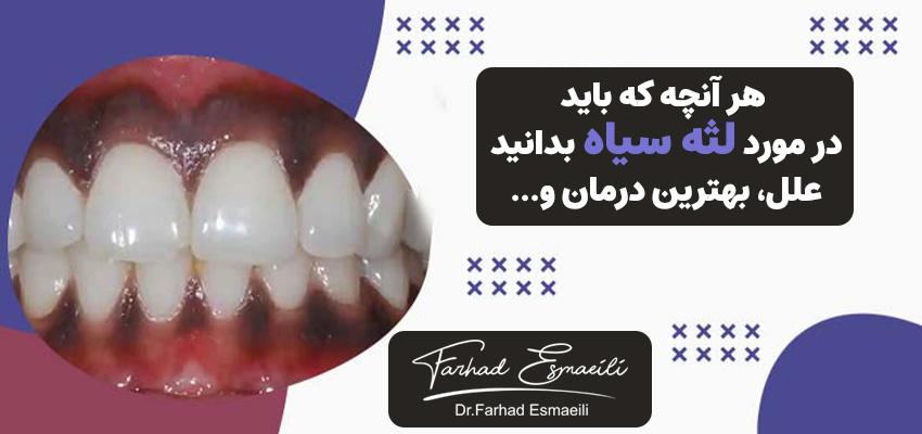 هر آنچه که باید در مورد لثه سیاه بدانید: علل، بهترین درمان و ... | دکتر فرهاد اسماعیلی