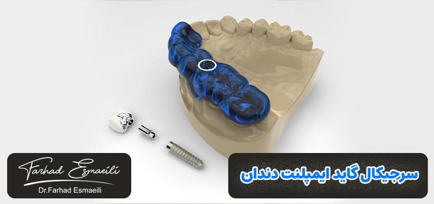 سرچیکال گاید چیست؟ | دکتر فرهاد اسماعیلی در اصفهان